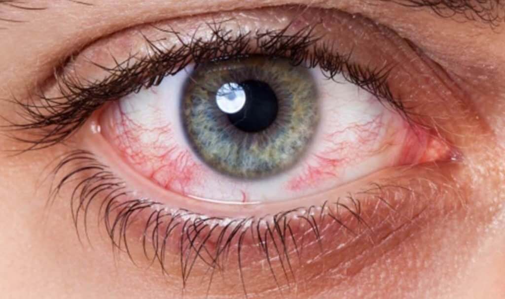Симптомы сухого глаза 